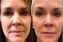 Radiesse Filler Injections clinic in Dubai