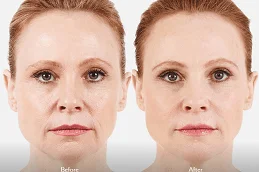 Results of Juvederm Filler Dubai