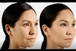 Results of Juvederm Filler in Dubai