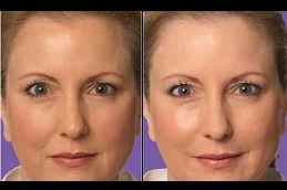Results of Juvederm Fillers Dubai & Abu Dhabi