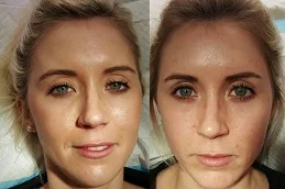 Results of Juvederm Fillers Dubai