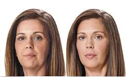 Results of Juvederm Fillers in Dubai & Abu Dhabi