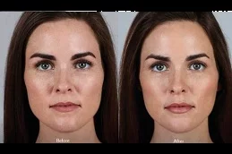 Results of Juvederm Fillers in Dubai