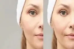 ,.Results of Karisma for Skin Dubai