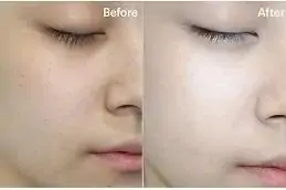 .Results of Karisma for Skin Dubai