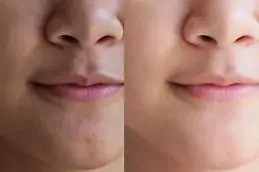 ,.Results of Karisma for Skin Dubai
