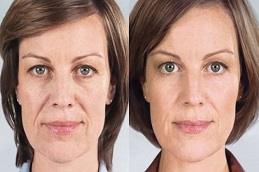 Results of Sculptra Face Treatment Dubai,.