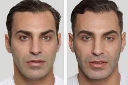 Results of Sculptra Face Treatment Dubai.