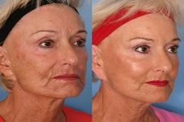 Results of Sculptra Face Treatment clinic in Dubai