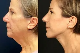Results of Skin Laser Treatment clinic Dubai,
