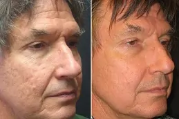 Results of Skin Laser Treatment clinic in Dubai,.