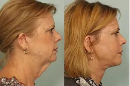 Results of Skin Laser Treatment clinic in Dubai.