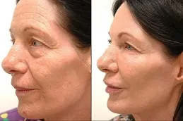 Results of Skin Laser Treatment clinic in Dubai