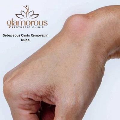 Sebaceous Cysts Removal in Dubai