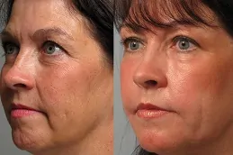 Skin Laser Treatment Before & After Dubai