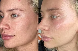 Skin Laser Treatment Before & After in Dubai