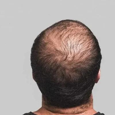 Stem Cell Hair Treatment in Dubai & Abu Dhabi