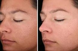 Sunekos Injections Dubai