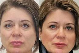 Sunekos Injections before & After