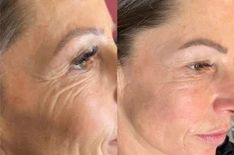 Sunekos Injections before & After.