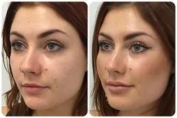 Sunekos Injections clinic in Dubai