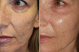 Sunekos Injections in Dubai