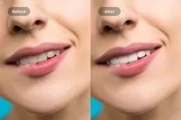 Teeth Whitening clinic in Dubai