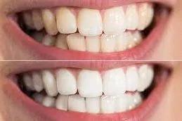 Teeth Whitening in Dubai & Abu Dhabi 