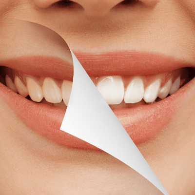 Teeth Whitening in Dubai & Abu Dhabi