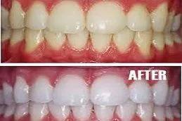 Teeth Whitening in Dubai before & After