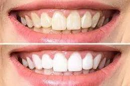Teeth Whitening in Dubai before & After