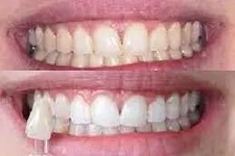 Teeth Whitening in Dubai before & After