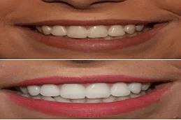 Teeth Whitening in Dubai