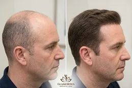 hair-Transplant-Before-After-Glamrous-Clinic.jpg