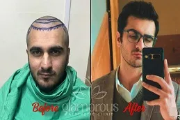hair-Transplnat-before-After-Clinic-in-Islamabad.jpg