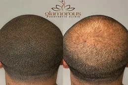 hair-Transplnat-before-After-in-Islamabad.jpg