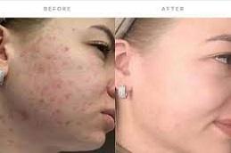 Biorepeel Treatment before & After.