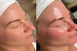 Biorepeel Treatment before & After.