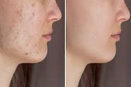 Biorepeel Treatment before & After