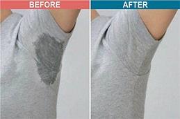 Botox Injections for Hyperhidrosis Dubai & Abu Dhabi