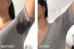 Botox Injections for Hyperhidrosis clinic Dubai & Abu Dhabi