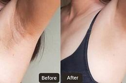 Botox Injections for Hyperhidrosis clinic in Dubai & Abu Dhabi