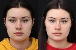 Buccal Fat Removal clinic in Dubai