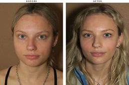 Buccal Fat Removal clinic in Dubai.