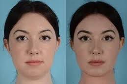 Buccal Fat Removal in Dubai