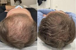 Dr CYJ Hair Fillers for Hair Growth Dubai.