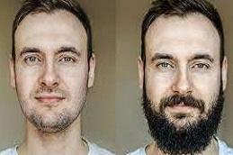 Dr CYJ Hair Fillers for Hair Growth before & After Dubai