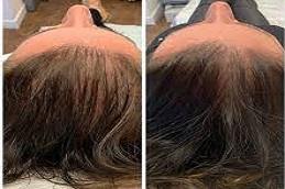 Dr CYJ Hair Fillers for Hair Growth before & After
