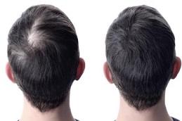 Dr CYJ Hair Fillers for Hair Growth before & After
