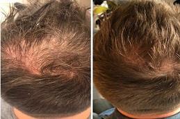 Dr CYJ Hair Fillers for Hair Growth in Dubai